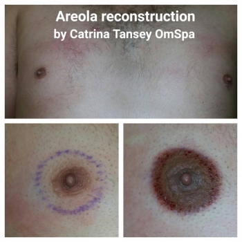 areola-men-enlargment