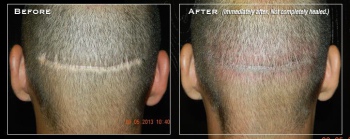 smp-scar-before-after