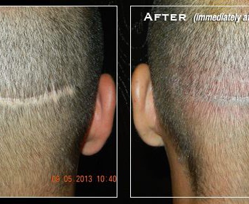 smp-scar-before-after