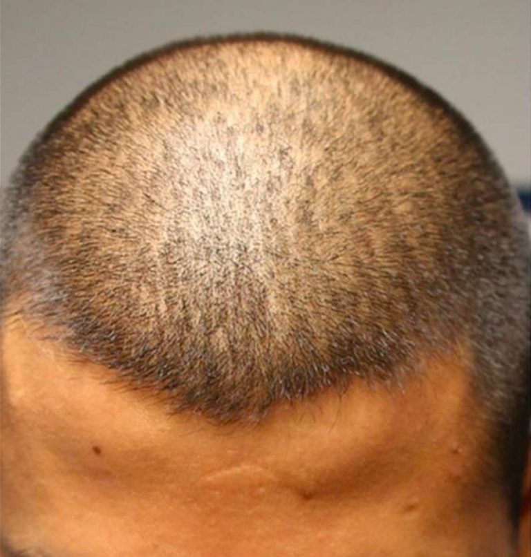 Scalp Micropigmentation Chicago Hair Tattoo Chicago & Beard