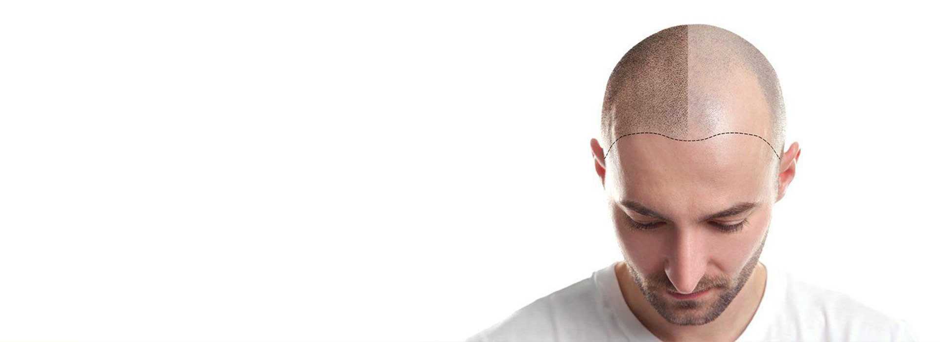 Scalp Micropigmentation Chicago Hair Tattoo Chicago & Beard