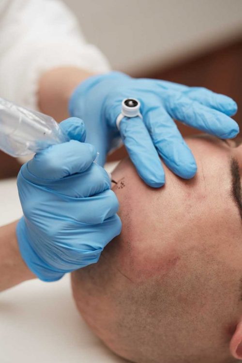 Scalp Micropigmentation Chicago Hair Tattoo Chicago & Beard