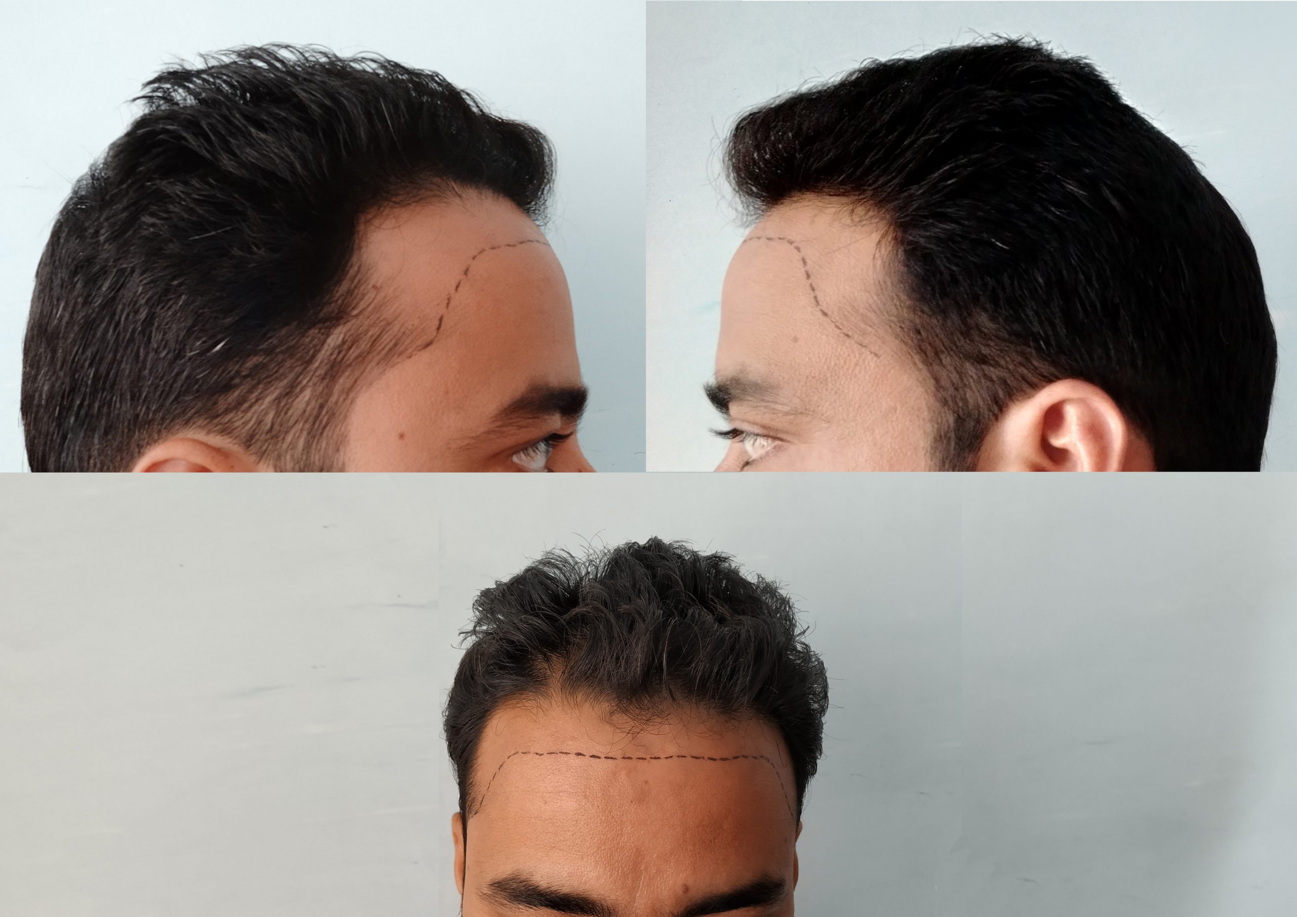 Scalp Micropigmentation Chicago Hair Tattoo Chicago & Beard