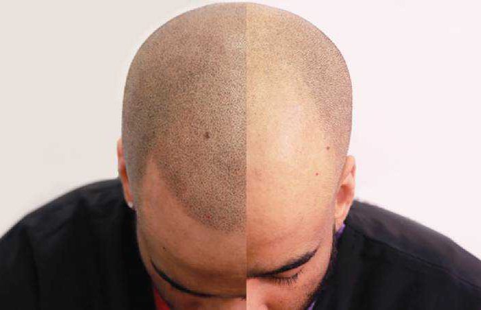Scalp-Micropigmentation